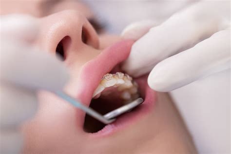 how to get kid used to palate expander