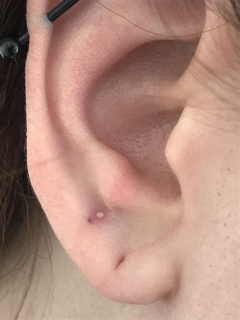 Found this gem on my ear today, the pop was so relieving, but was too