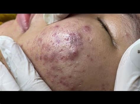 loan nguyen acne treatment & Blackheads removal - YouTube