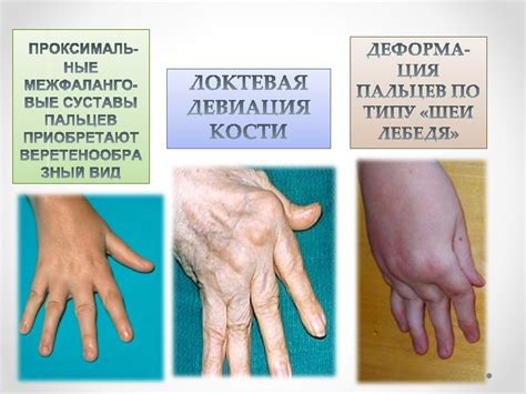 РЕВМАТОИДНЫЙ АРТРИТ РЕВМАТОИДНЫЙ АРТРИТ RHEUMA