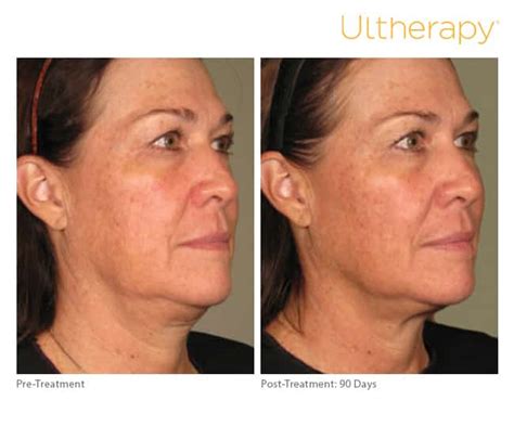 Ultherapy – Why are there mixed reviews? - BLUME