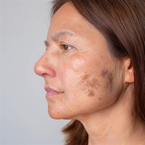 Manchas De Melasma No Rosto - Melasma no Rosto: Guia Completo de Causas, Tratamentos e Prevenção ...