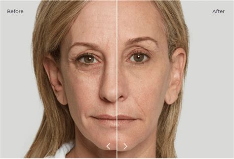 Liftera Antes E Depois - Liftera 2: Lifting Natural | Como Funciona? Veja o Antes e Depois!