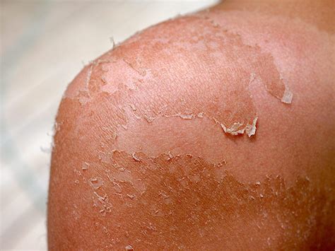 Sun Burn Peeling Treatment