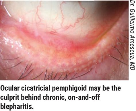 Anterior Blepharitis What is Anterior Blepharitis? Causes & Treatment ...