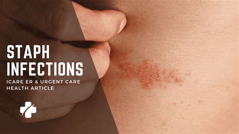 staph infection rash   infoupdateorg
