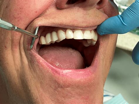 Artificial Tooth Options Dental Implants - Hale Family Dentistry