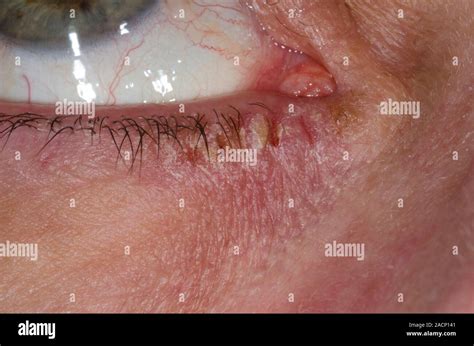 Eczema around the eye. Close-up of the eye of a 51-year-old female ...
