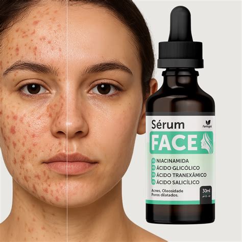 Melhor Serum Clareador De Manchas - Sérum Clareador de Manchas Facial Cravos e Espinhas - 30ml - Envio ...