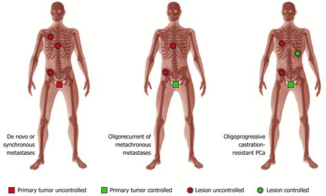Prostate Cancer Spread To Bones Life Expectancy Uk - CancerWalls