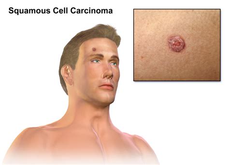 Skin Cancer On Face Signs
