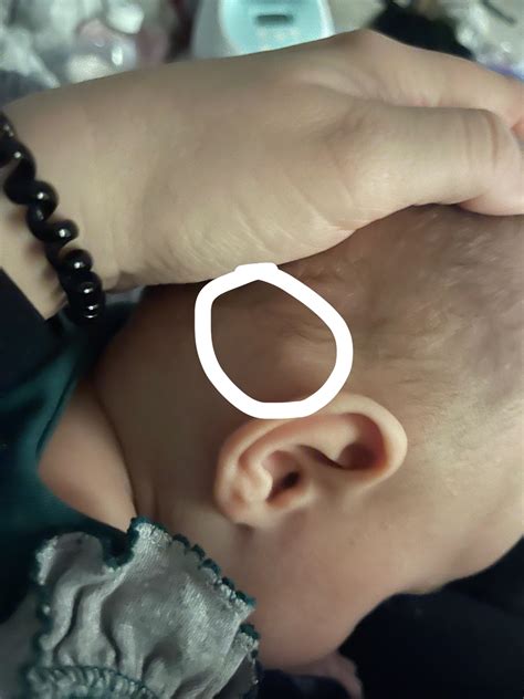 Lump On Back Of Head Or Skull That Hurts To Touch Hard Caput