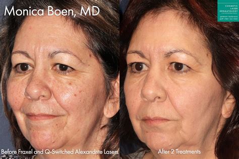 Alexandrite Laser in San Diego - Cosmetic Laser Dermatology Skin ...