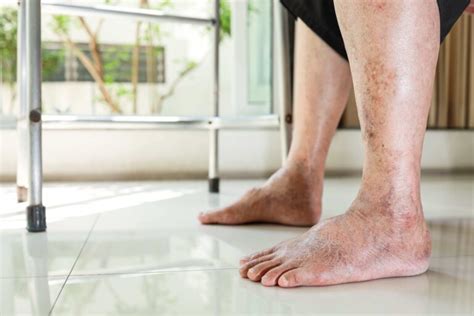 Leg Edema: Causes, Treatment & Its Impact on Wound Care