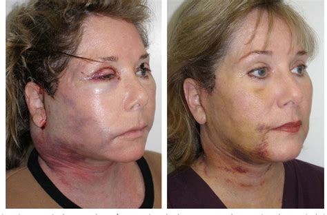 Figure 28 from Complications in facelift surgery and their prevention ...