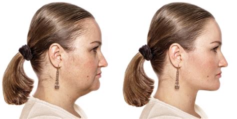 premium photo double chin    facelift