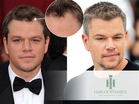 The Real Story Behind Matt Damon's Alleged Hair Transplant