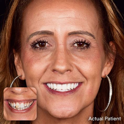 Dental Implants in Charleston SC | Doctors Implants