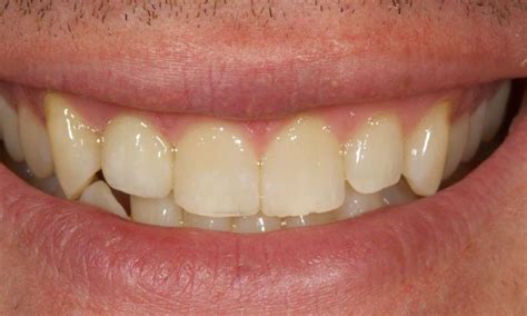 Root canal post CEREC crown Before & After | Rogers AR