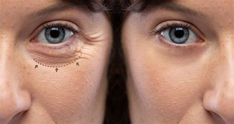 Bolsa Nos Olhos Cirurgia Antes E Depois - Cirurgia Plastica Antes E Depois Dos Olhos Veja O Antes E Depois De
