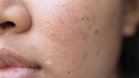 How To Get Rid Of Acne Scars
