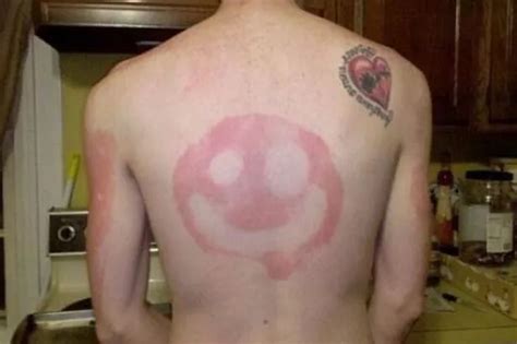 Sunburn gallery: Best and worst suntan disasters - Daily Record