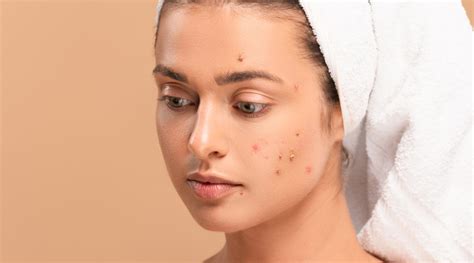Acne: Causes, Types, and Treatments | Sozo Clinic