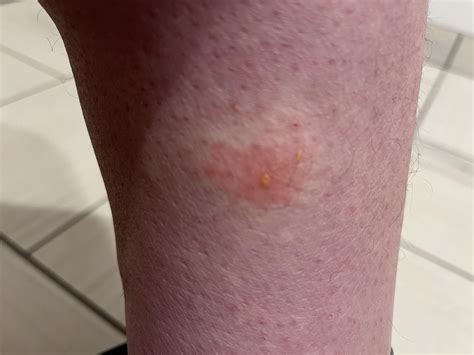 Possible bug bite, continues to swell with yellow liquid leaking out