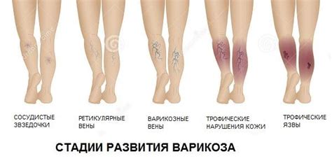 Варикоз вен нижних конечностей - это очень серьезная и опасная болезнь