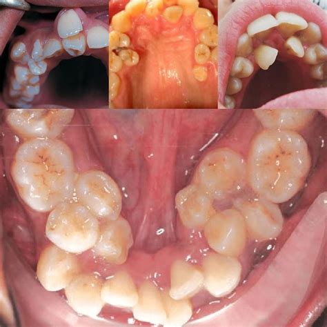 Hyperdontia