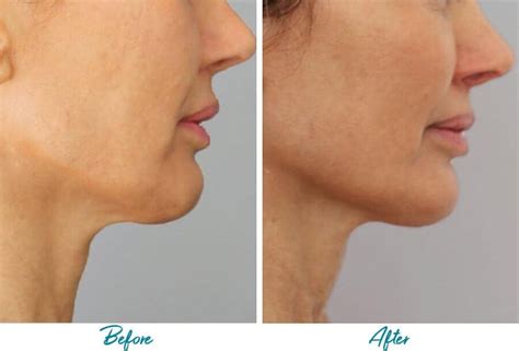 Patient 18616383 | Profound RF Skin Tightening Before & After Photos ...