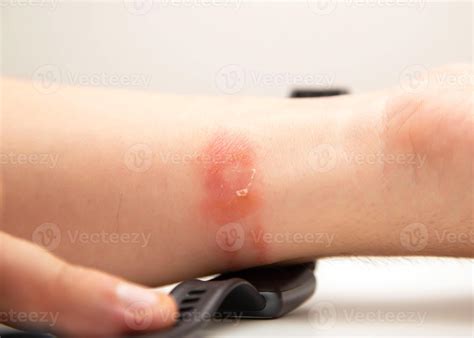 Irritation, redness and itching on the skin after wearing a watch or