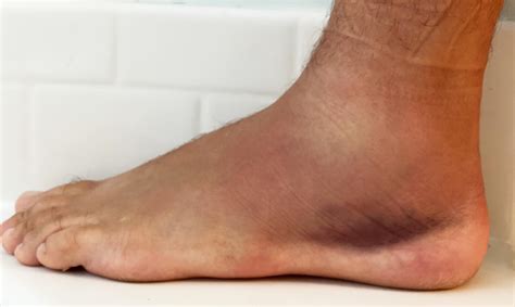 Ankle Pain