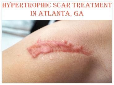 PPT – HYPERTROPHIC SCAR TREATMENT IN ATLANTA, GA PowerPoint ...