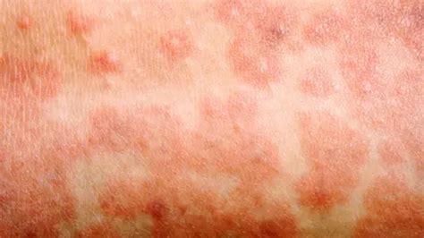 measles outbreak  questions answered