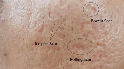 hilangkan parut jerawat  berkesan  diagnosa