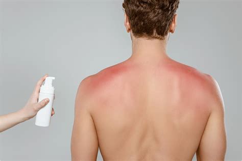Creme Para Queimadura Solar - O melhor creme para queimaduras solares: Classificação e dicas para ...