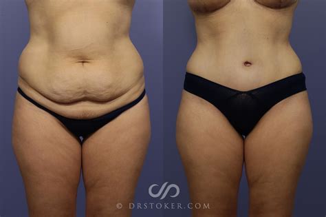 Tummy Tuck Before And After Stretch Marks