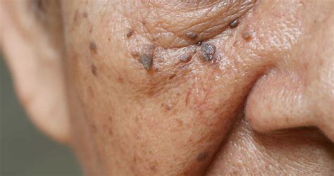 skin tags stratum clinics
