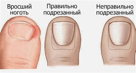 Лечим вросший ноготь на ноге: 11 мощных домашних рецептов