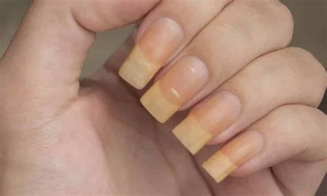 Unha Amarelada O Que Pode Ser - Unhas amarelas: conheça as 11 possíveis causas e como resolver