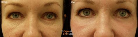 laser resurfacing  eyes renewal skin spa