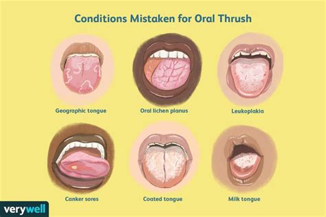 oral thrush      tongue spots