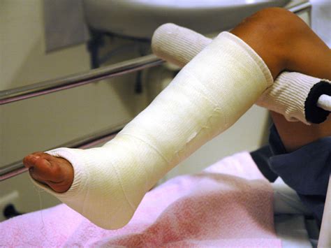 Clip Art Broken Leg at Jett Tishler blog
