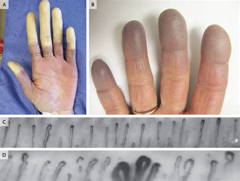 raynauds disease faqs