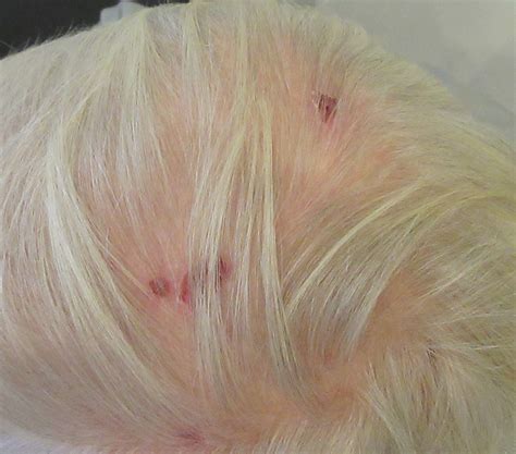Basal Cell Carcinoma on Scalp | BCC Image Example – Mr Tehrani