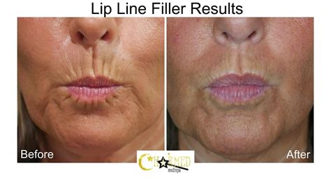 Lip And Smoker Lines Improvement With Natural Looking Results – Charmed