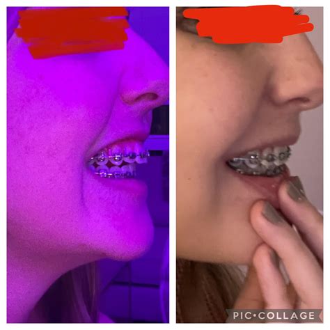 377 best Overbite images on Pholder | Invisalign, Aww and Braces