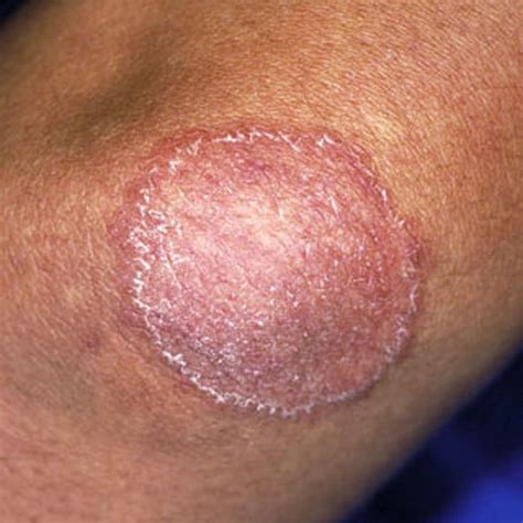 Lyme Disease Pictures of Bullseye Rash