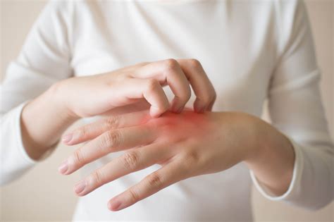Dengue Da Coceira Nas Mãos E Pés